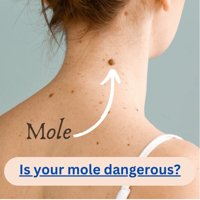 Mole